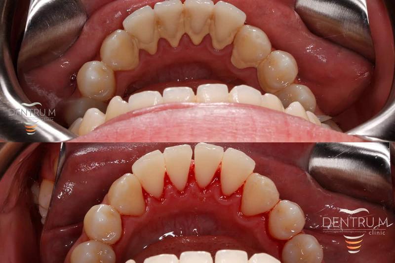 Skuteczne sposoby na usunięcie kamienia z prysznica, kabiny, wann i płytek